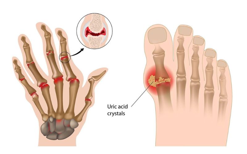 Nhận biết sớm dấu hiệu bệnh gout là việc vô cùng quan trọng, không thể xem nhẹ