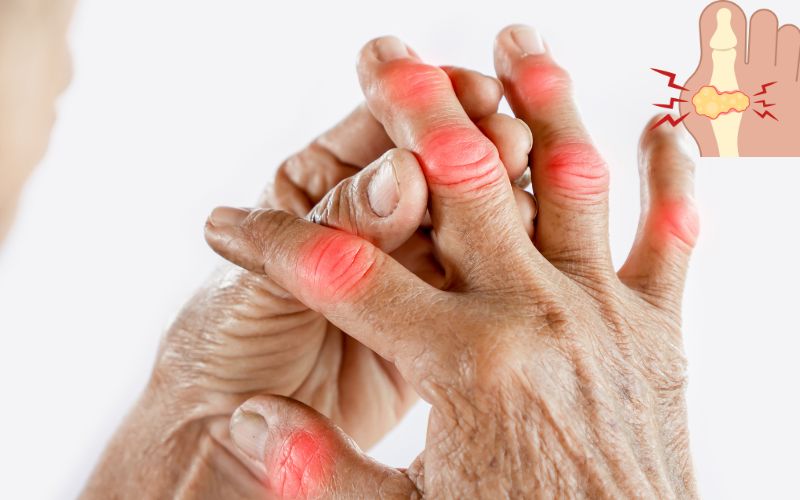Dấu hiệu bệnh gout khi sưng nóng và đỏ ở các khớp