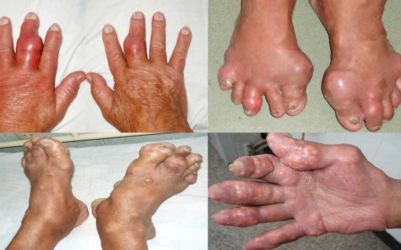 Dấu hiệu bệnh gout nghiêm trọng khi thấy xuất hiện các nốt tophi
