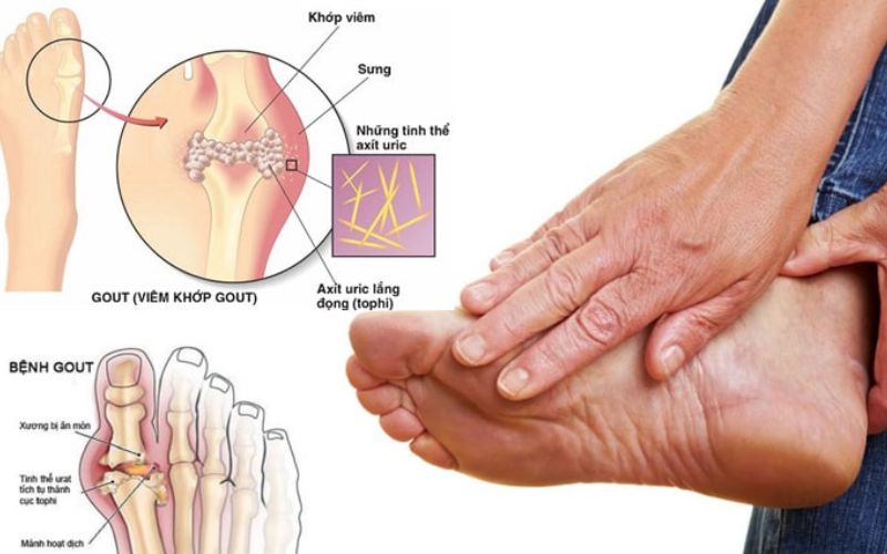 Các giai đoạn xảy ra dấu hiệu bệnh gout thường gặp nhất